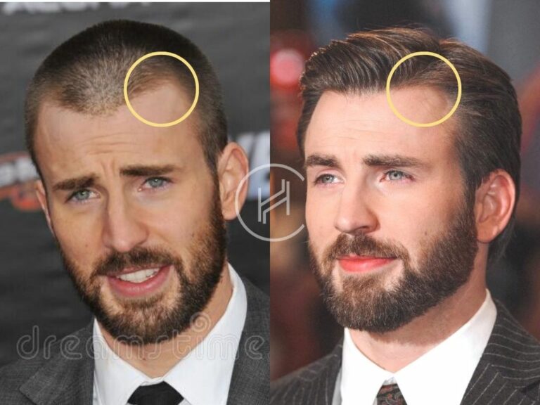 Chris Evans Hair Transplant - Hair Loss & Technical Analysis