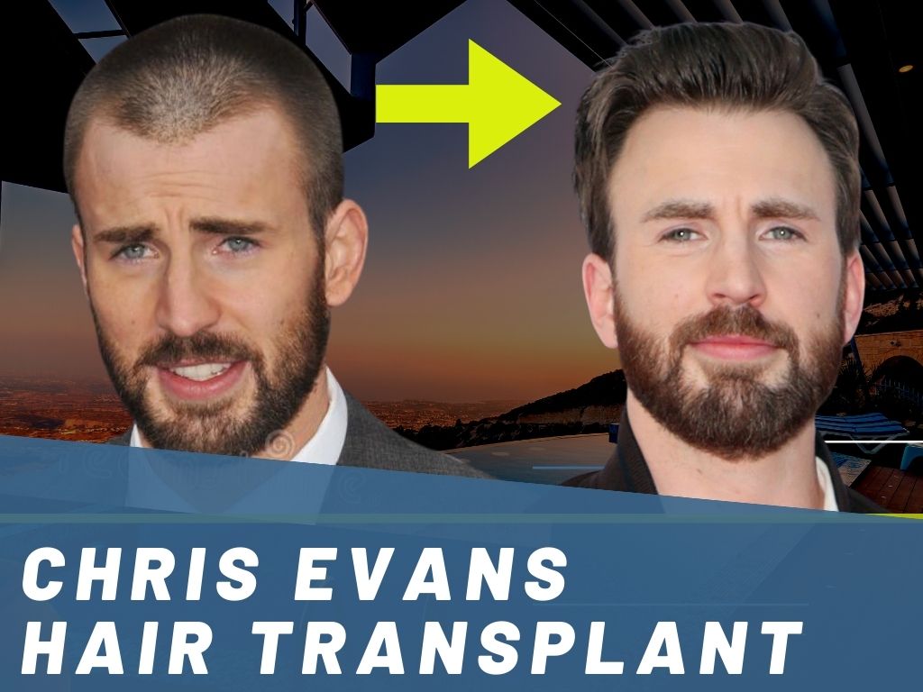 Chris Evans Hair Transplant - Hair Loss & Technical Analysis