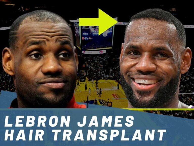 LeBron James Hair Transplant Hair Loss & Technical Analysis