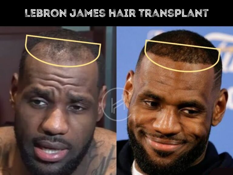 LeBron James Hair Transplant Hair Loss & Technical Analysis