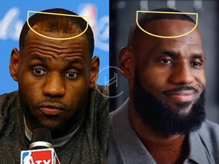 LeBron James Hair Transplant Hair Loss & Technical Analysis