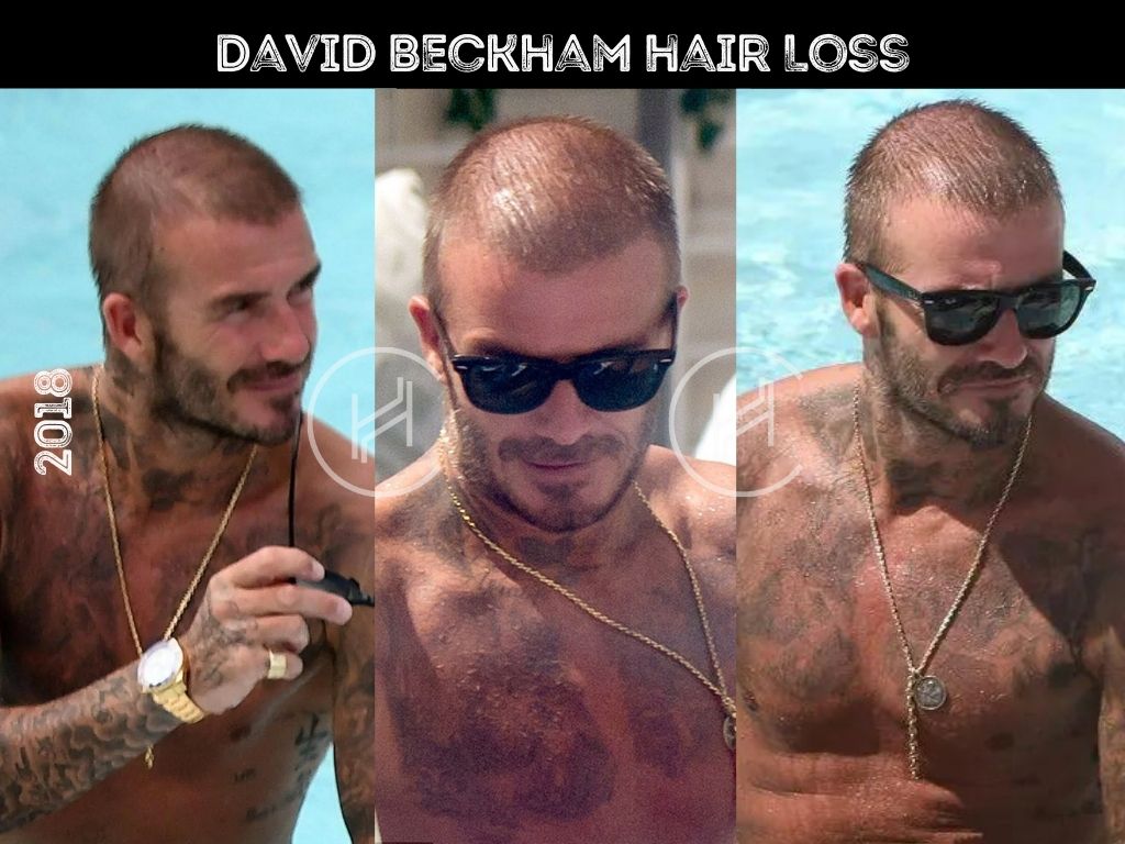 David Beckham might be losing his hair – and gaining an opportunity