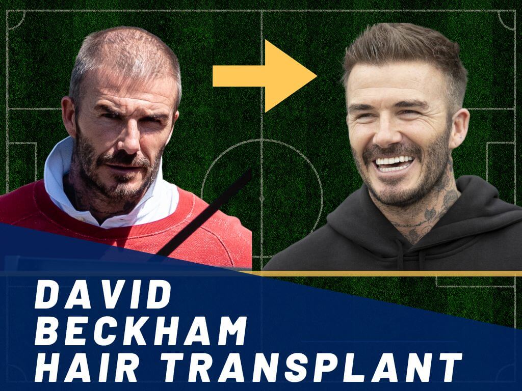 Everything about David Silvas hair transplant