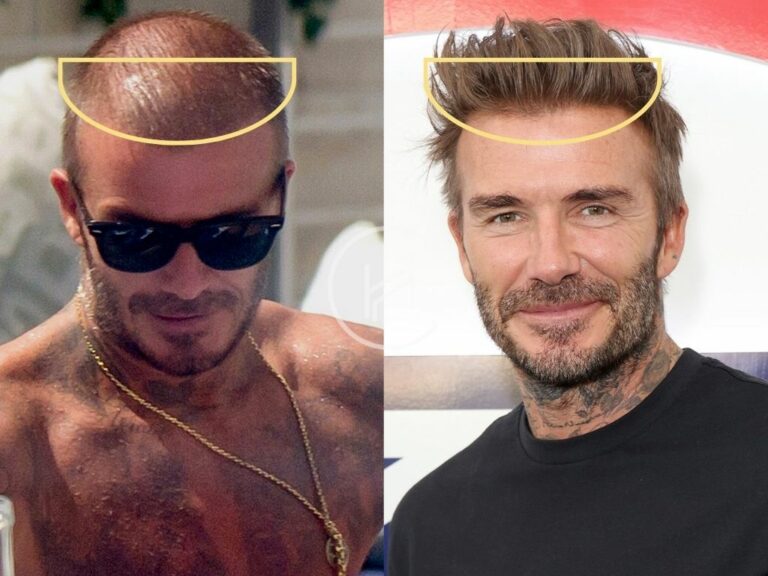 David Beckham Hair Transplant Before After Photo 768x576 