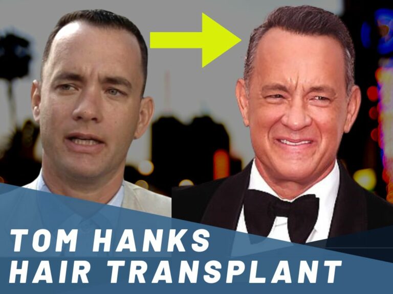 Tom Hanks Hair Transplant - Hair Loss & Technical Analysis