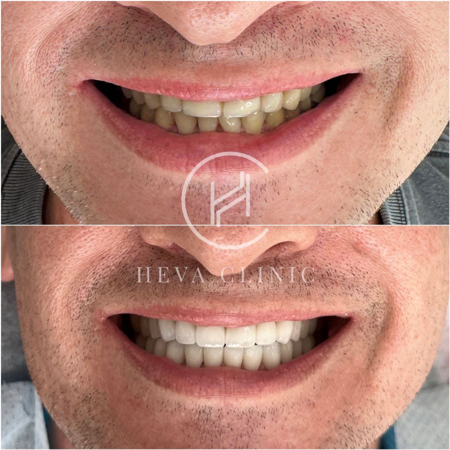 Before and After' Teeth Repair Results
