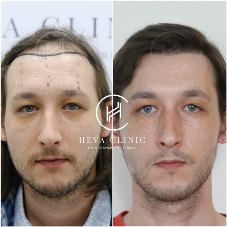 Hair Transplant Recovery Timeline 0 14 Months Photos 8147