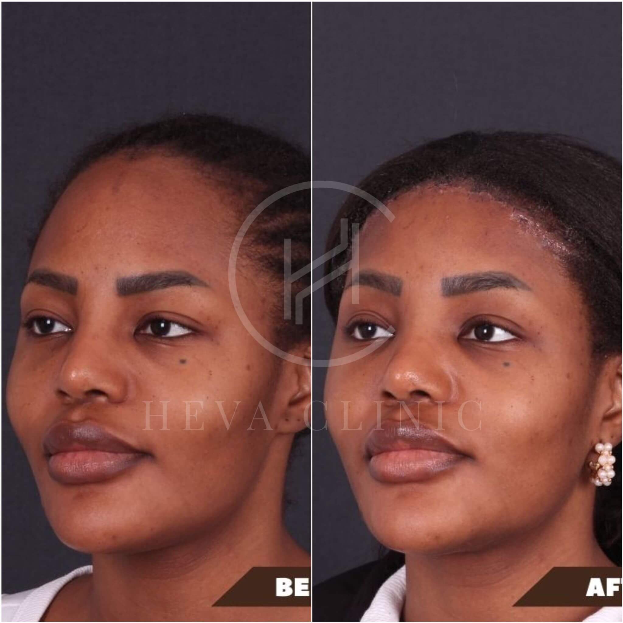 Forehead Reduction Before And After Photos Unfiltered Results