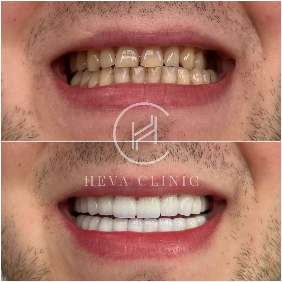 Dental Treatment Before & After Photos - Unfiltered Results