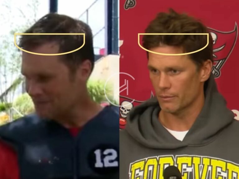 Tom Brady Hair Transplant Hair Loss And Technical Analysis 