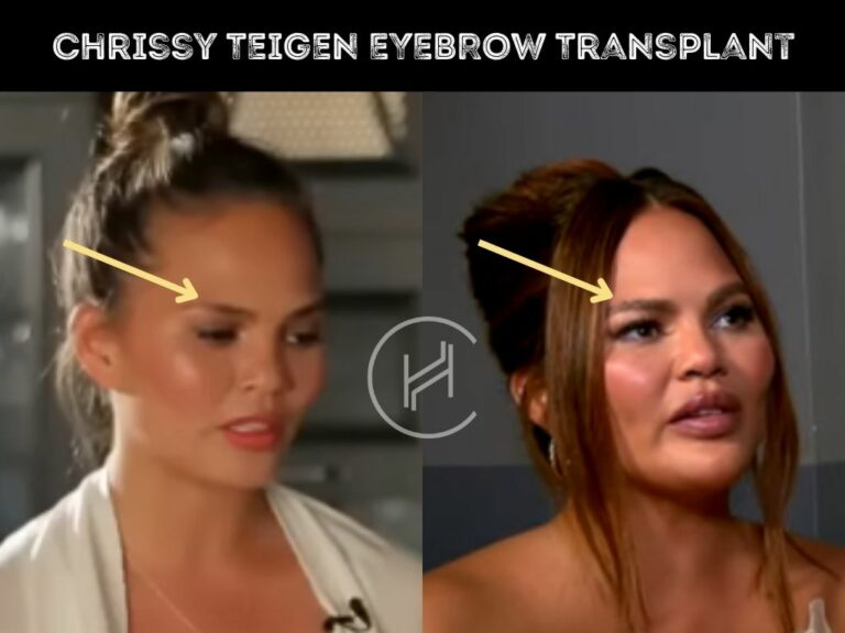 Chrissy Teigen Eyebrow Transplant Before And After Pictures