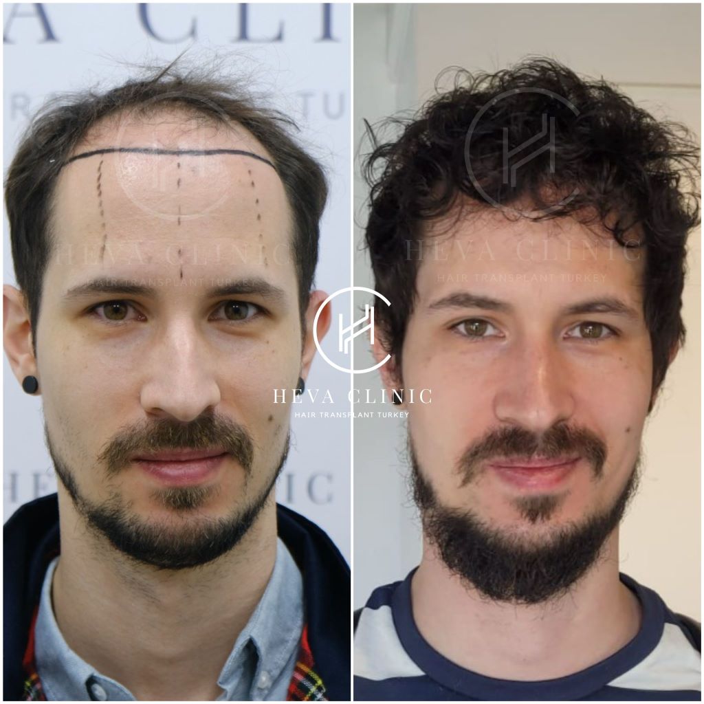 Details More Than 137 Hair Transplant Before And After Super Hot Dedaotaonec