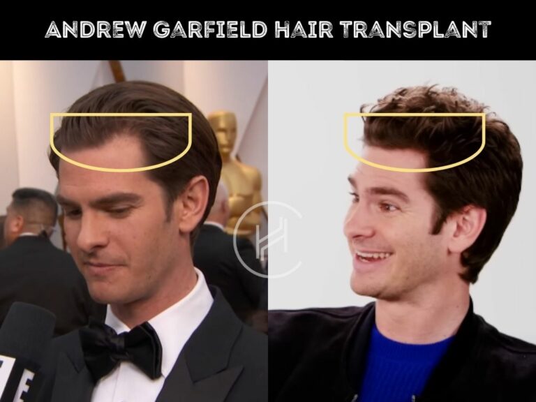 Henry Cavill Hair Transplant Hair Loss Technical Analysis