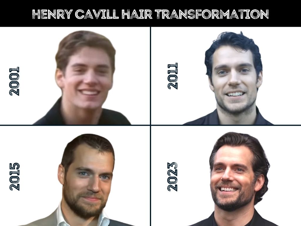 Henry Cavill Hair Transplant - Hair Loss & Technical Analysis