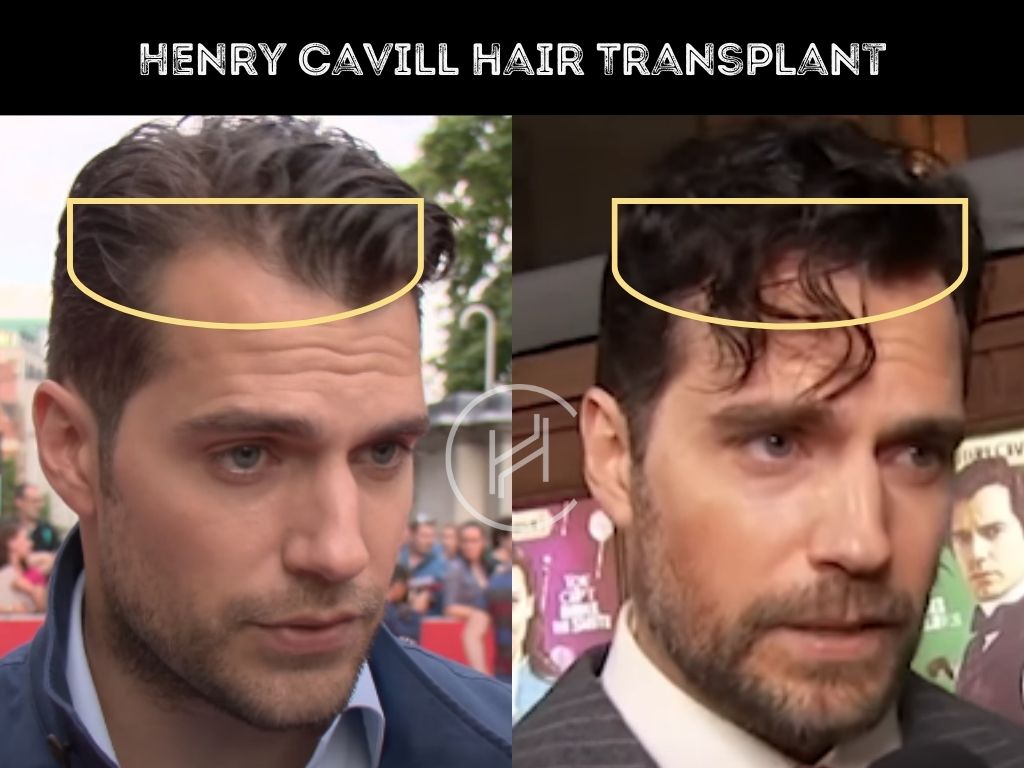 Henry Cavill Hair Transplant - Hair Loss & Technical Analysis