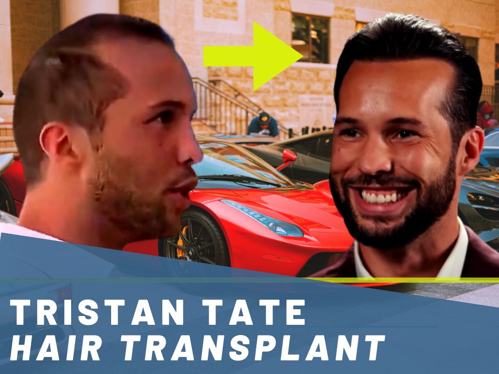 tristan tate hair transplant analysis banner