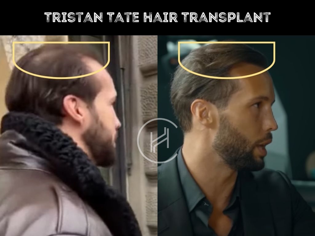 tristan tate - hair transplant before after result