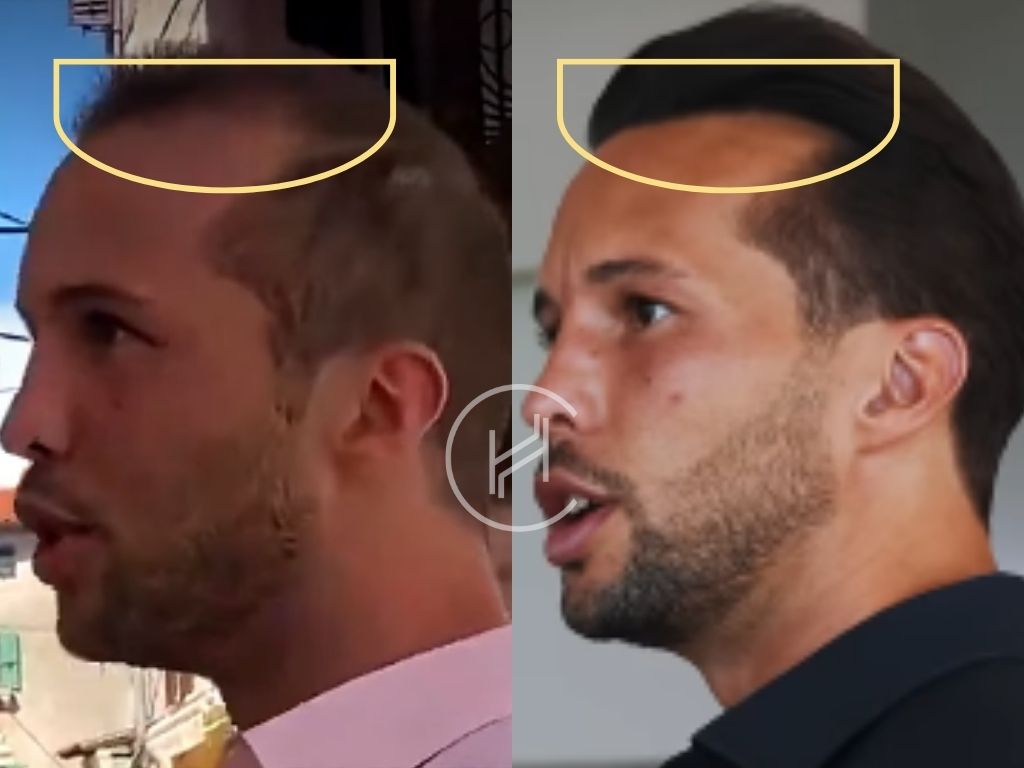 tristan tate hair transplant before and after result