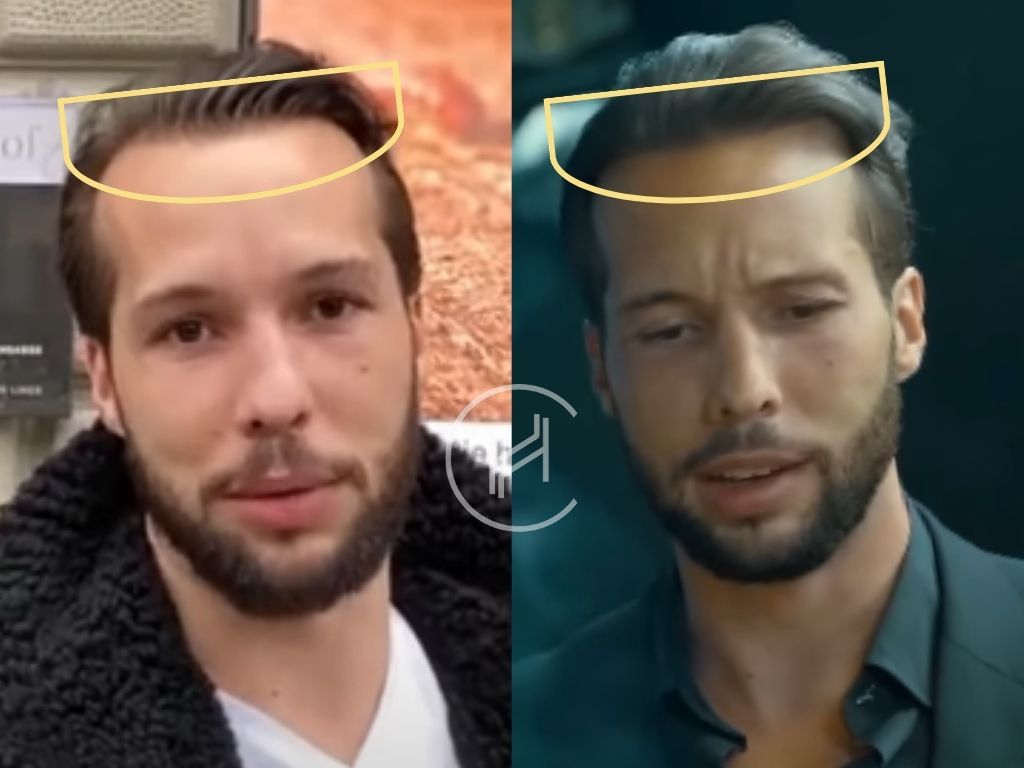 tristan tate - hair transplant before and after
