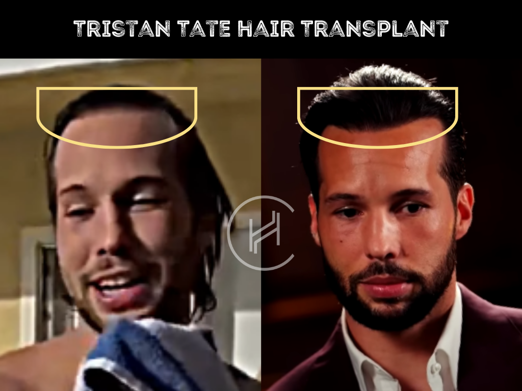 tristan tate hair transplant result before after