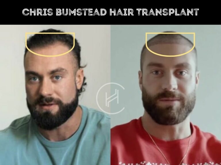 Chris Bumstead (CBum) Hair Transplant - Hair Restoration Analysis