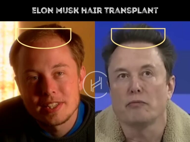 Elon Musk Hair Transplant - Hair Loss Analysis with Photos