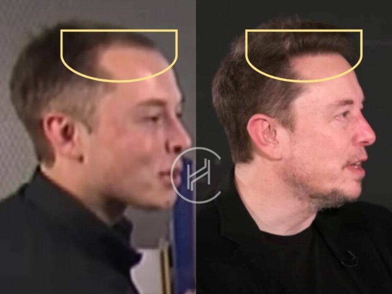 Elon Musk Hair Transplant - Hair Loss Analysis with Photos