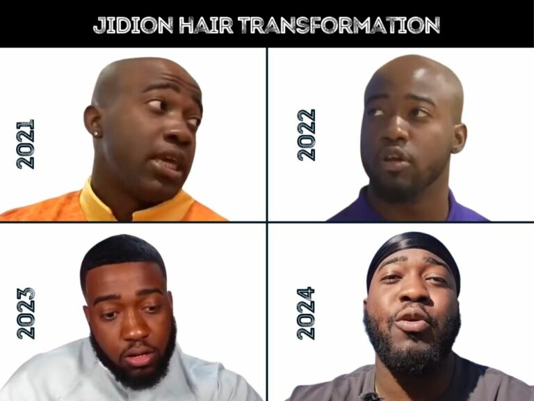 JiDion Hair Transplant - Hair Loss & Technical Analysis