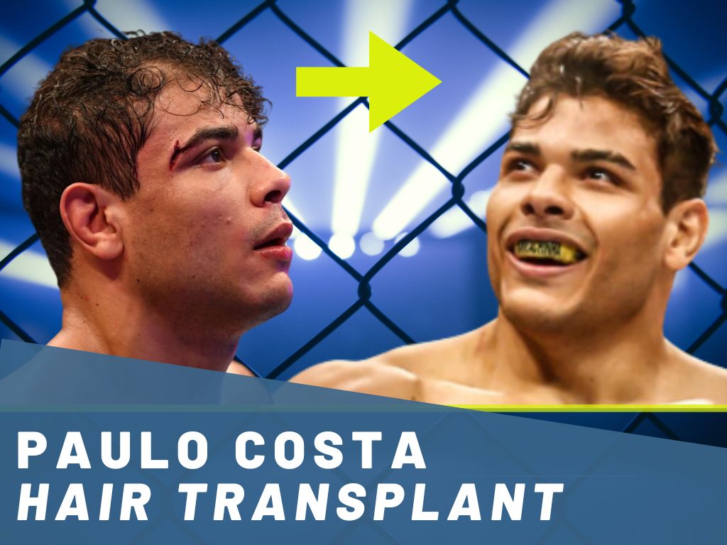 paulo costa - hair transplant analysis banner