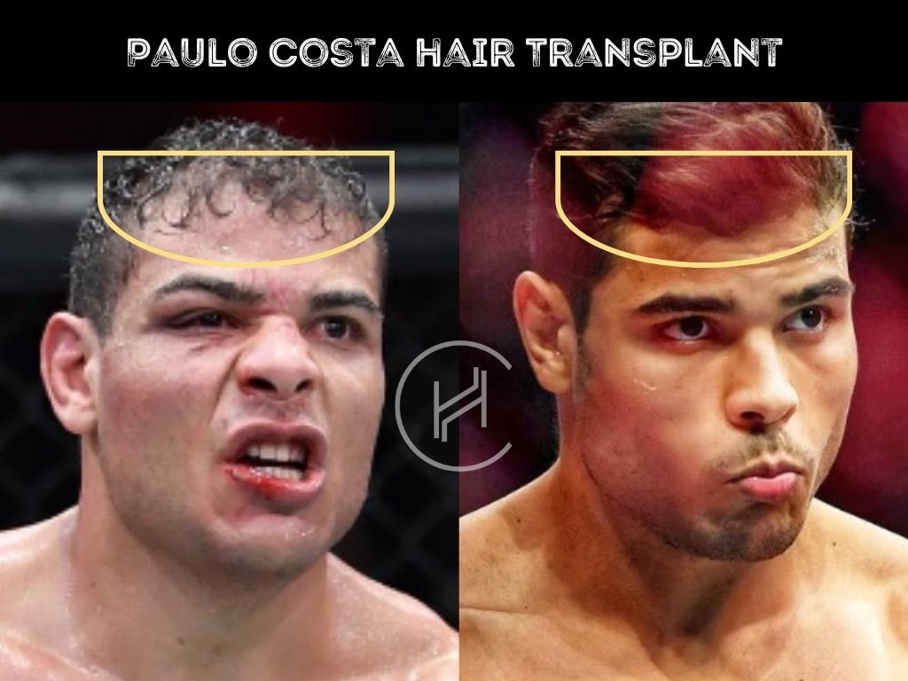 paulo costa - hair transplant before after result