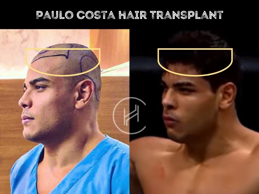 paulo costa - hair transplant before & after