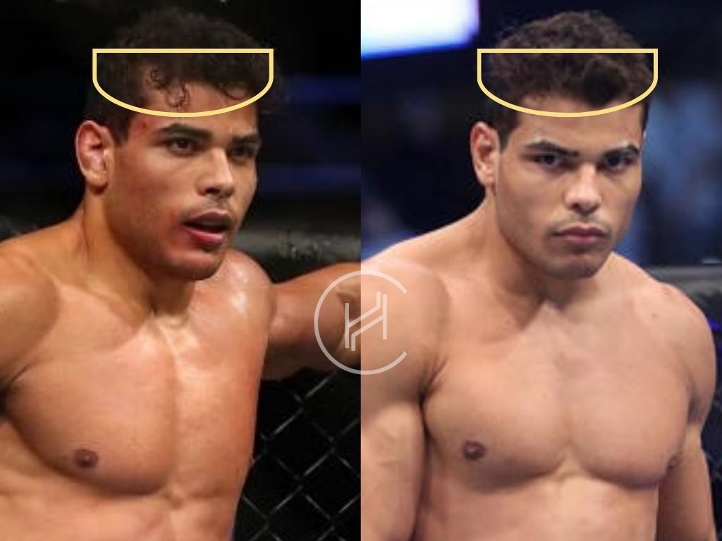 paulo costa hair transplant before and after result