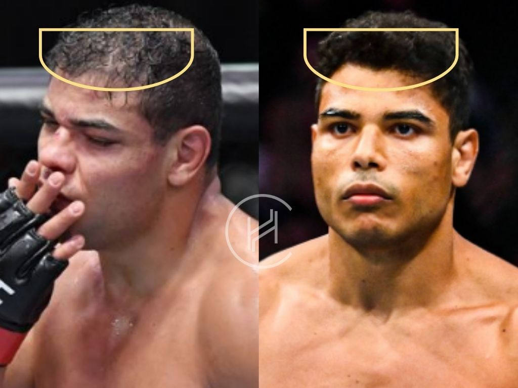 paulo costa - hair transplant before and after
