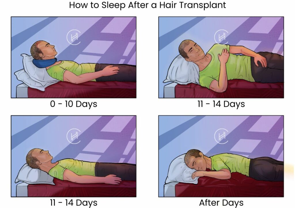 How To Sleep After A Hair Transplant? (with Pictures) - Heva Clinic