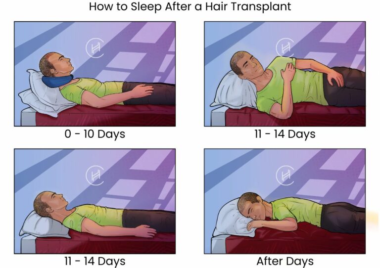 How to Sleep After a Hair Transplant? (With Pictures) - Heva Clinic