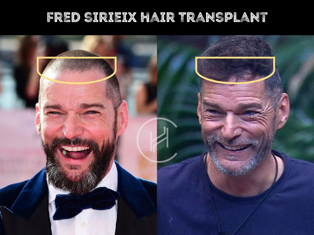 Fred Sirieix Hair Transplant - Hair Loss & Technical Analysis