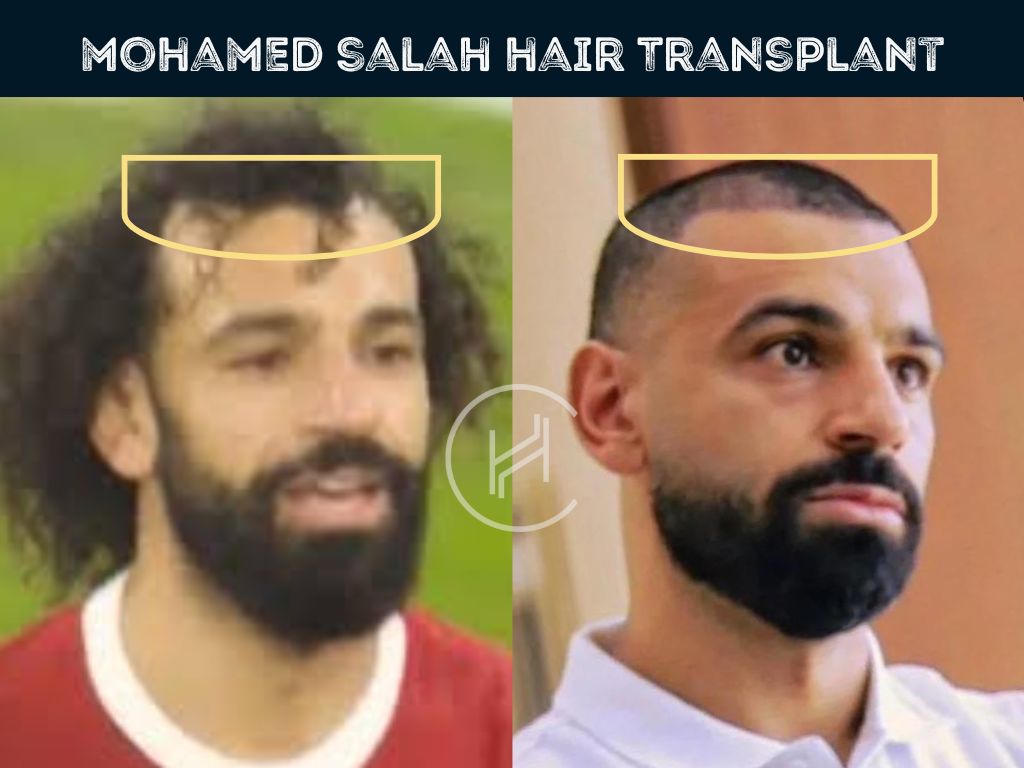 Mo Salah Hair Transplant - Hair Loss & Technical Analysis