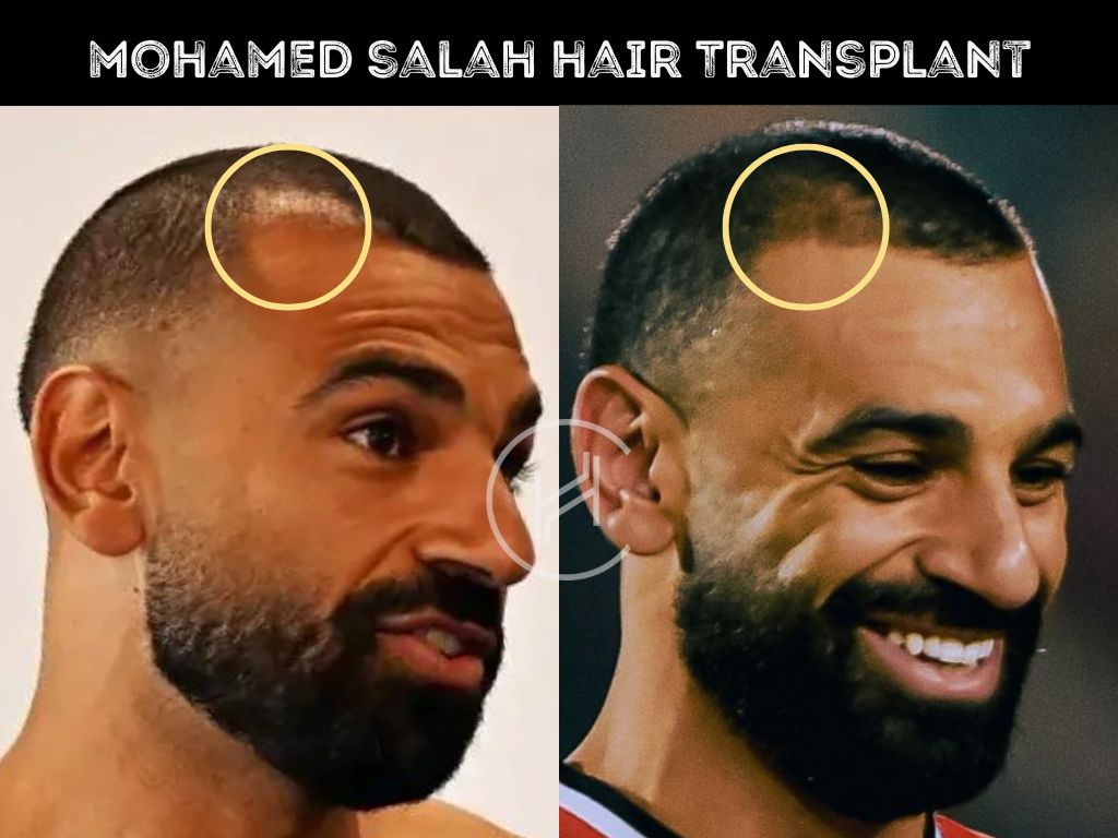 Mo Salah Hair Transplant - Hair Loss & Technical Analysis