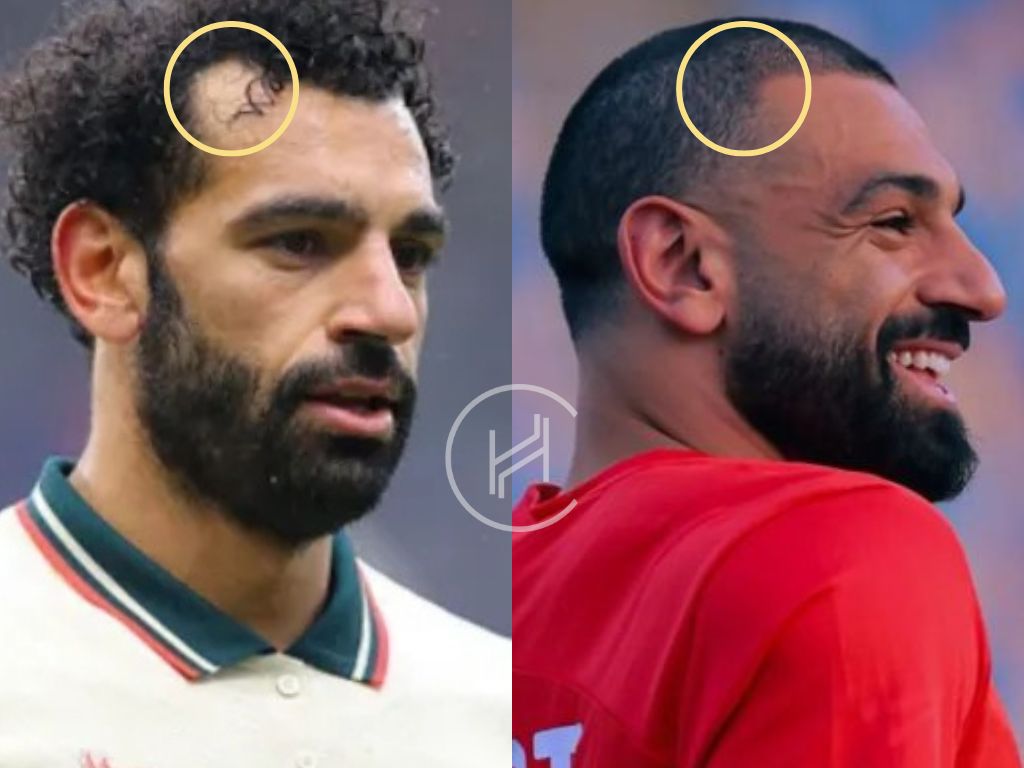 Mo Salah Hair Transplant - Hair Loss & Technical Analysis