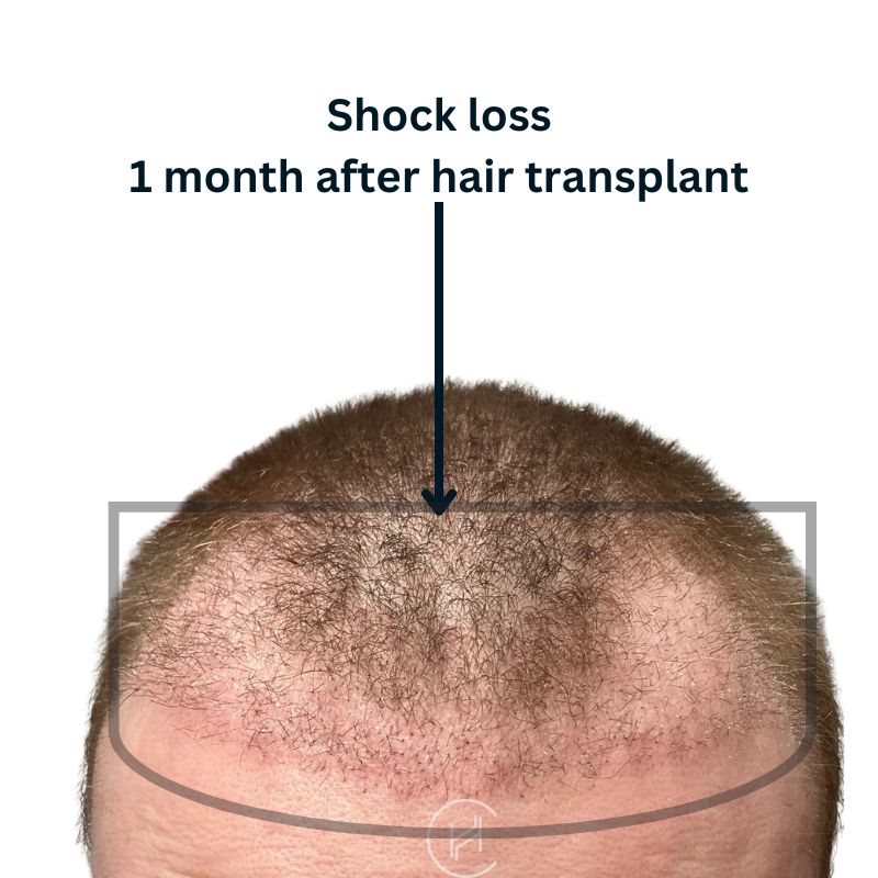 Shock Loss After Hair Transplant - Post-op Hair Shedding Timeline