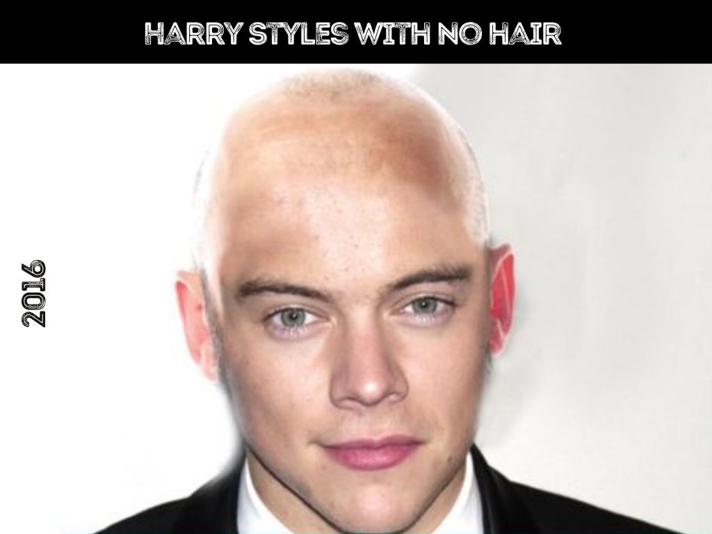 Harry Styles Hair Transplant - Hair Loss & Technical Analysis