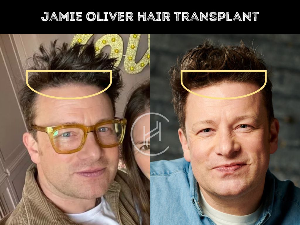 Jamie Oliver Hair Transplant - Hair Loss & Technical Analysis